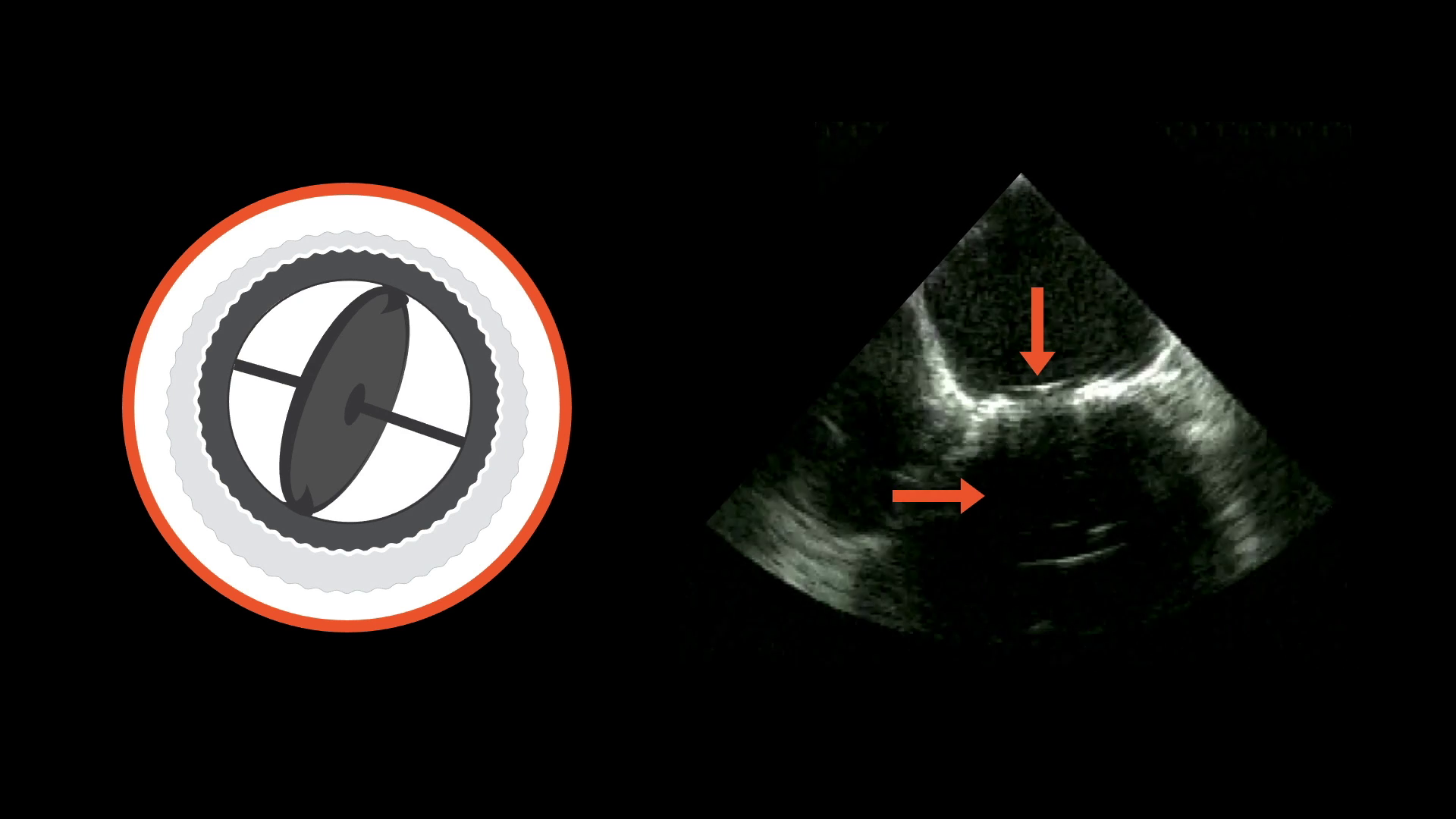 Prosthetic Valves in Ultrasound